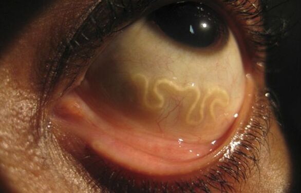 Loa Loa solucanı insan gözünde yaşıyor ve körlüğe neden oluyor